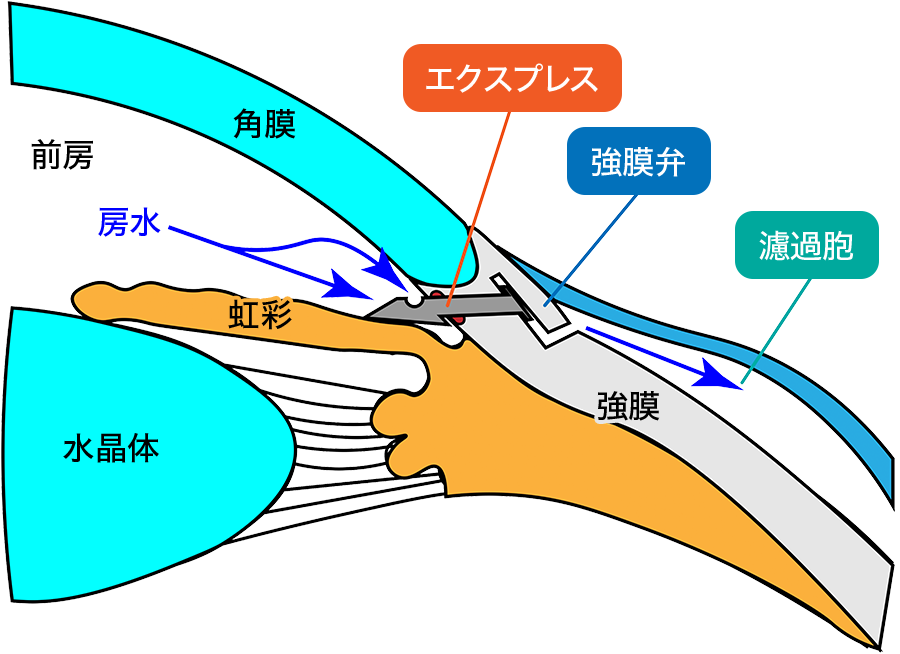 線維柱帯を切開して、房水の排水を改善