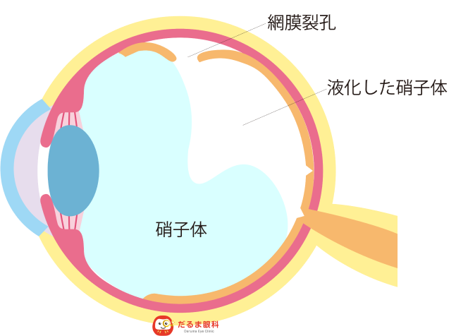 網膜裂孔