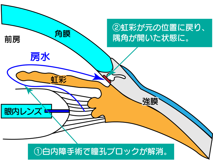 白内障手術後