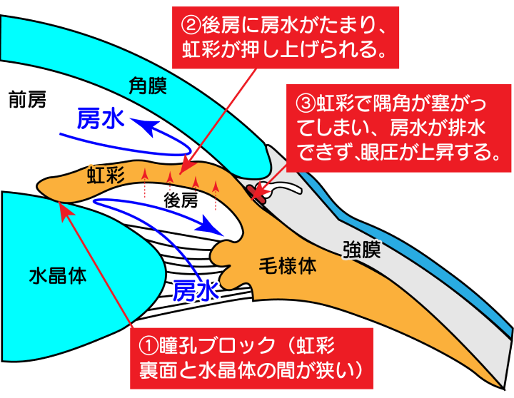 白内障手術前