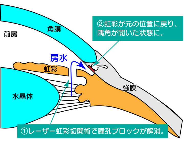 レーザー後