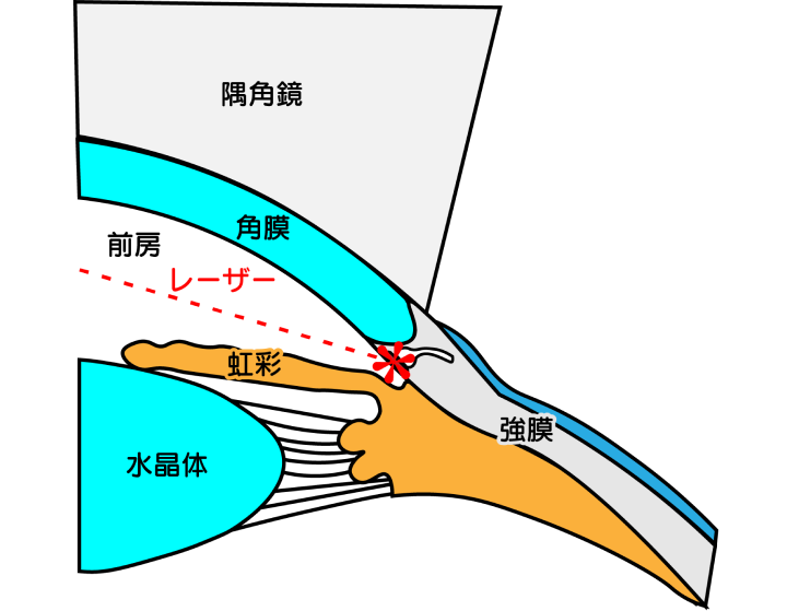 レーザー線維柱帯形成術