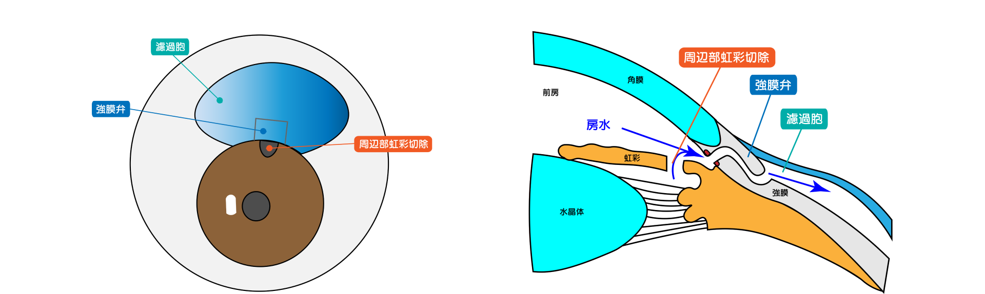 線維柱帯切除術　図解