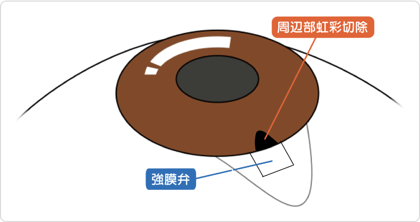 虹彩切除　図解