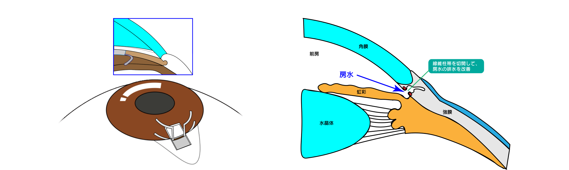 線維柱帯切開術（眼外法）　図解