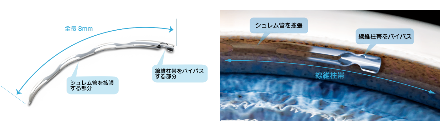 緑内障手術 | 治療メニュー | だるま眼科（群馬県高崎市）