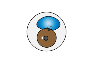 トラベクレクトミー