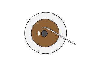隅角癒着解離術