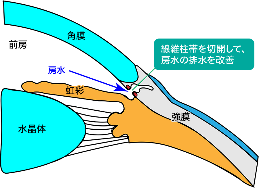 線維柱帯を切開して、房水の排水を改善