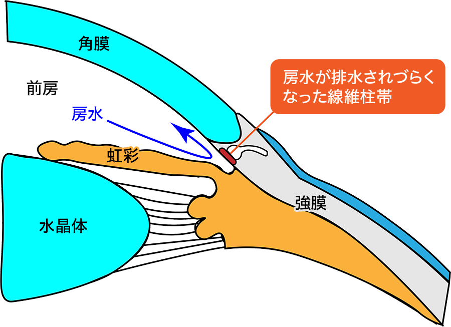 房水が排水されづらくなった線維柱帯