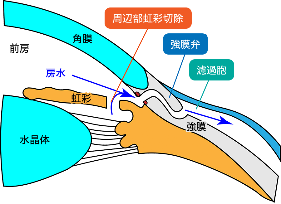 強膜弁、周辺部虹彩切除の作成イメージ
