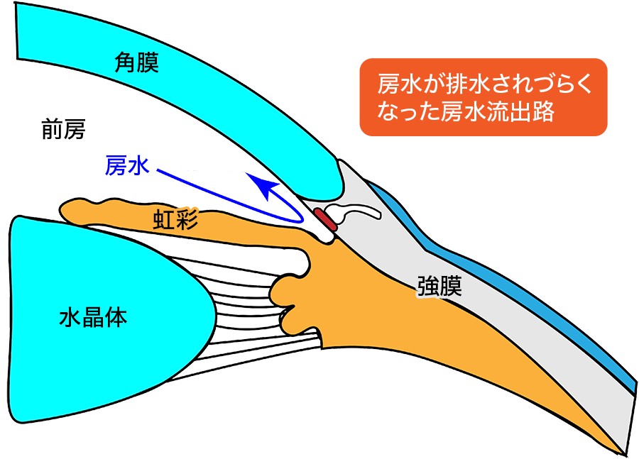 房水が排水されづらくなった線維柱帯